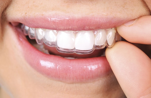 Invisalign West New York
