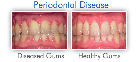 Periodontal Disease - West New York