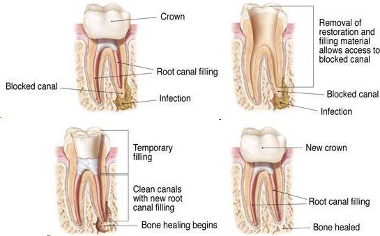 Root Canal Retreatment (Endodontist Retreatment)
