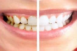 Dental Cleanings in West New York NJ 07093