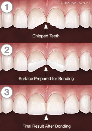 Dental Bonding in West New York