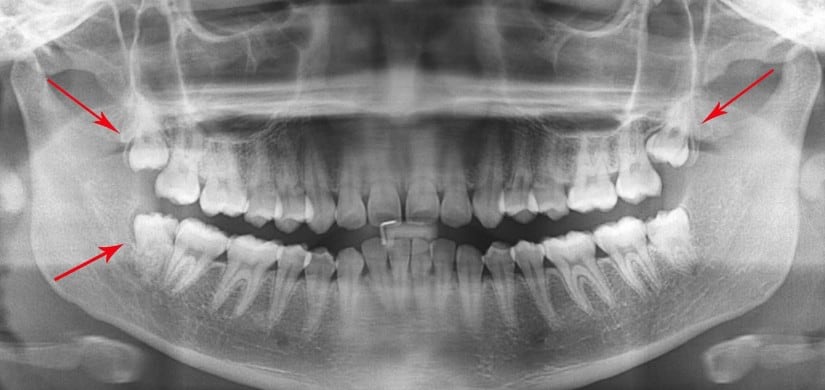 Wisdom Tooth Extraction West New York